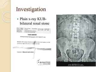 Investigation
 Plain x-ray KUB-
bilateral renal stone
 