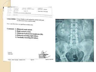 bilateral renal stone.pptx