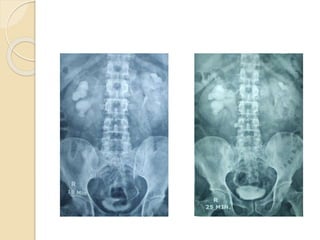 bilateral renal stone.pptx