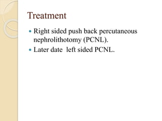 Treatment
 Right sided push back percutaneous
nephrolithotomy (PCNL).
 Later date left sided PCNL.
 