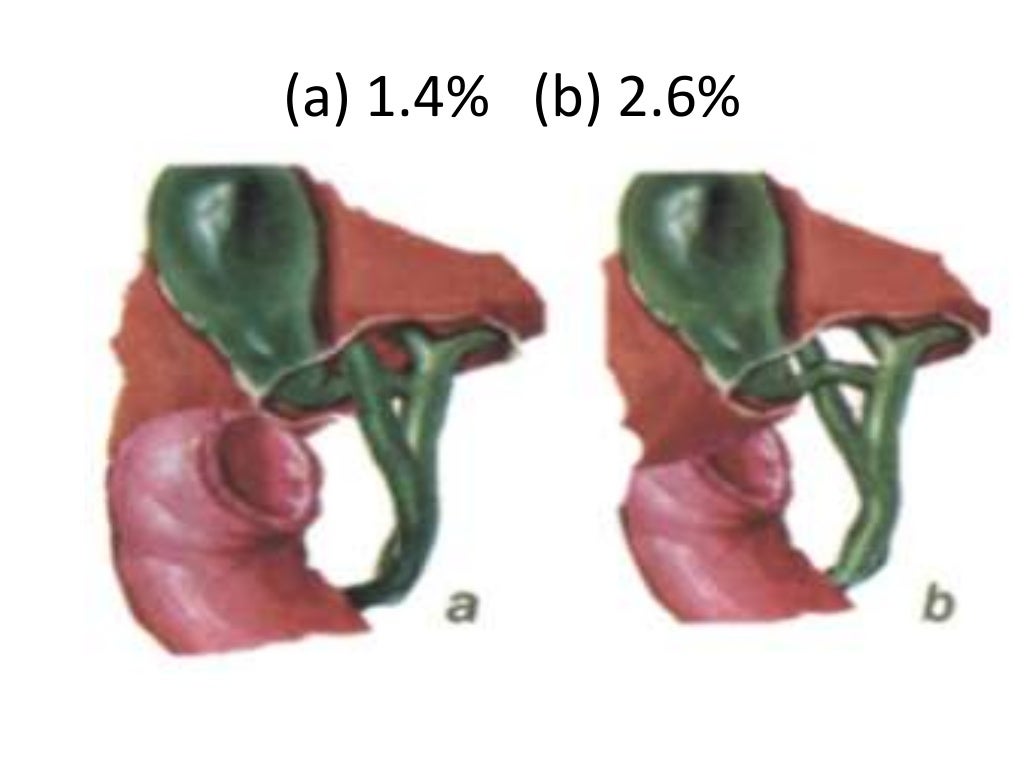 Bile Duct Injuries Bile Duct Injuries