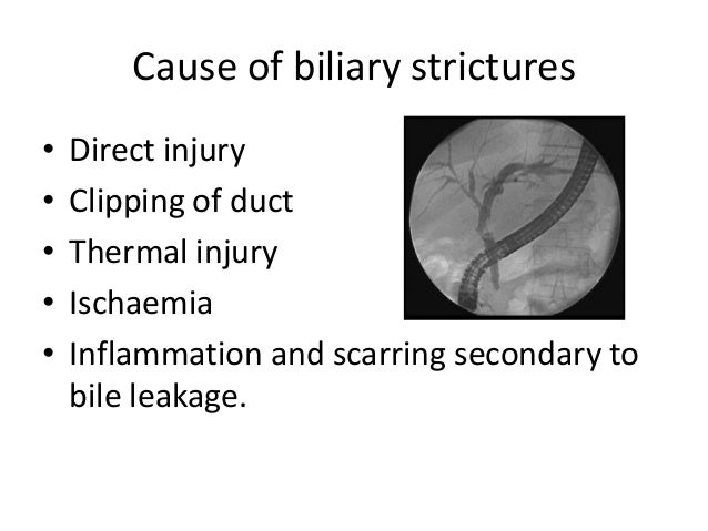 Bile Duct Injuries Bile Duct Injuries