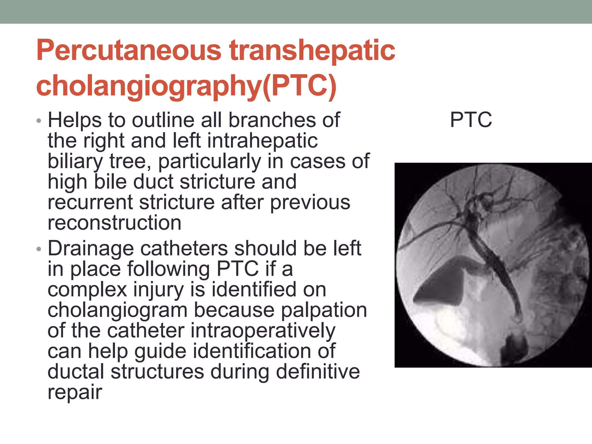 Bile duct injuries BDI | PPTX