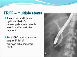 ERCP – multiple stents
Lateral duct wall injury or
cystic duct leak 
transampullary stent controls
leak & provides definitive
treatment
Distal CBD must be intact to
augment internal
drainage with endoscopic
stent
 