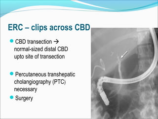 ERC – clips across CBD
CBD transection 
normal-sized distal CBD
upto site of transection
Percutaneous transhepatic
cholangiography (PTC)
necessary
Surgery
 