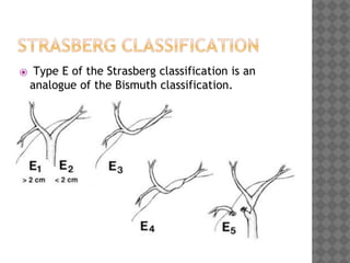 Lundborg's Classification Bile duct injuries | PPTX
