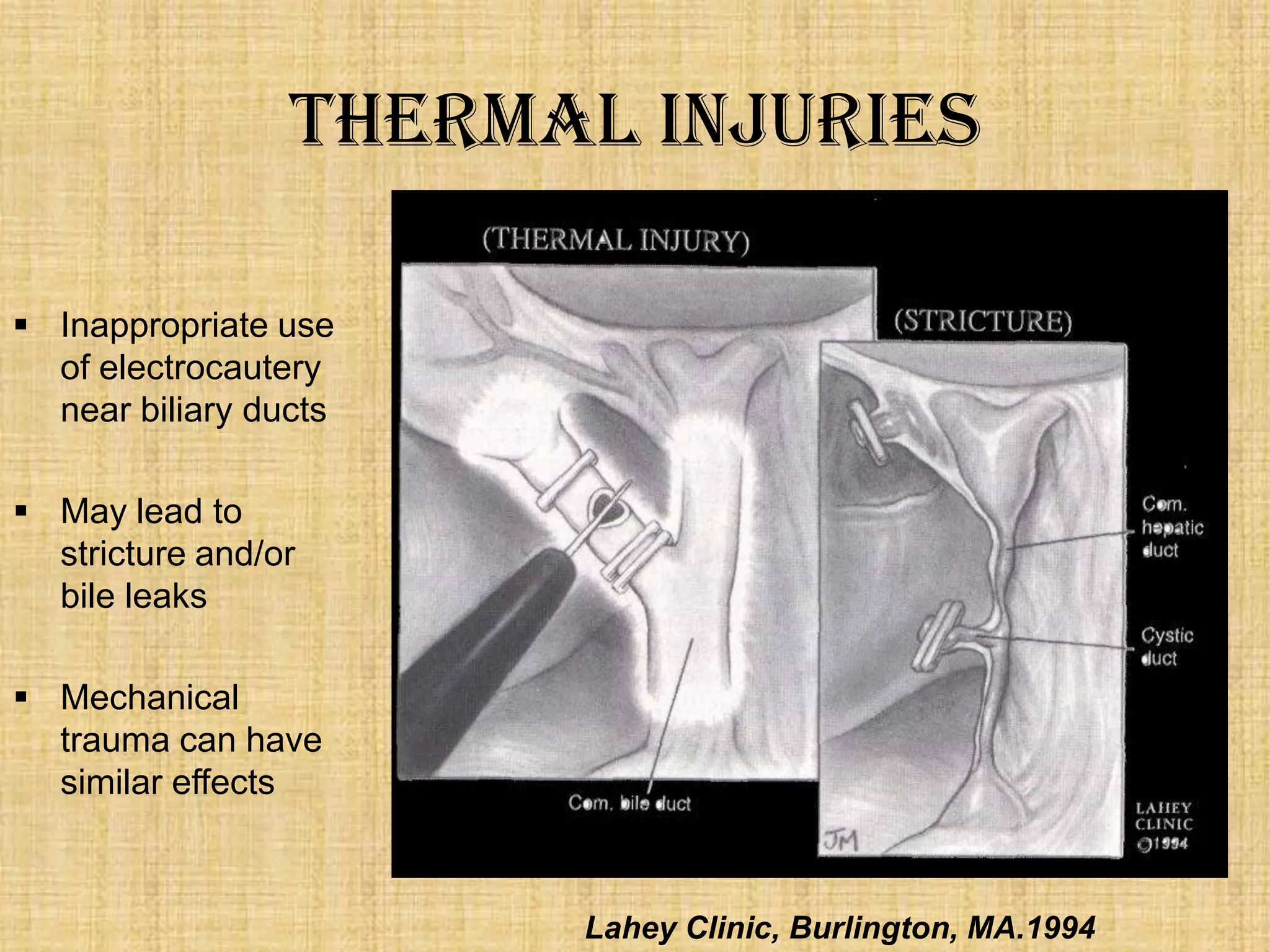 Thermal Injuries
 Inappropriate use
of electrocautery
near biliary ducts
 May lead to
stricture and/or
bile leaks
 Mechanical
trauma can have
similar effects

Lahey Clinic, Burlington, MA.1994

 