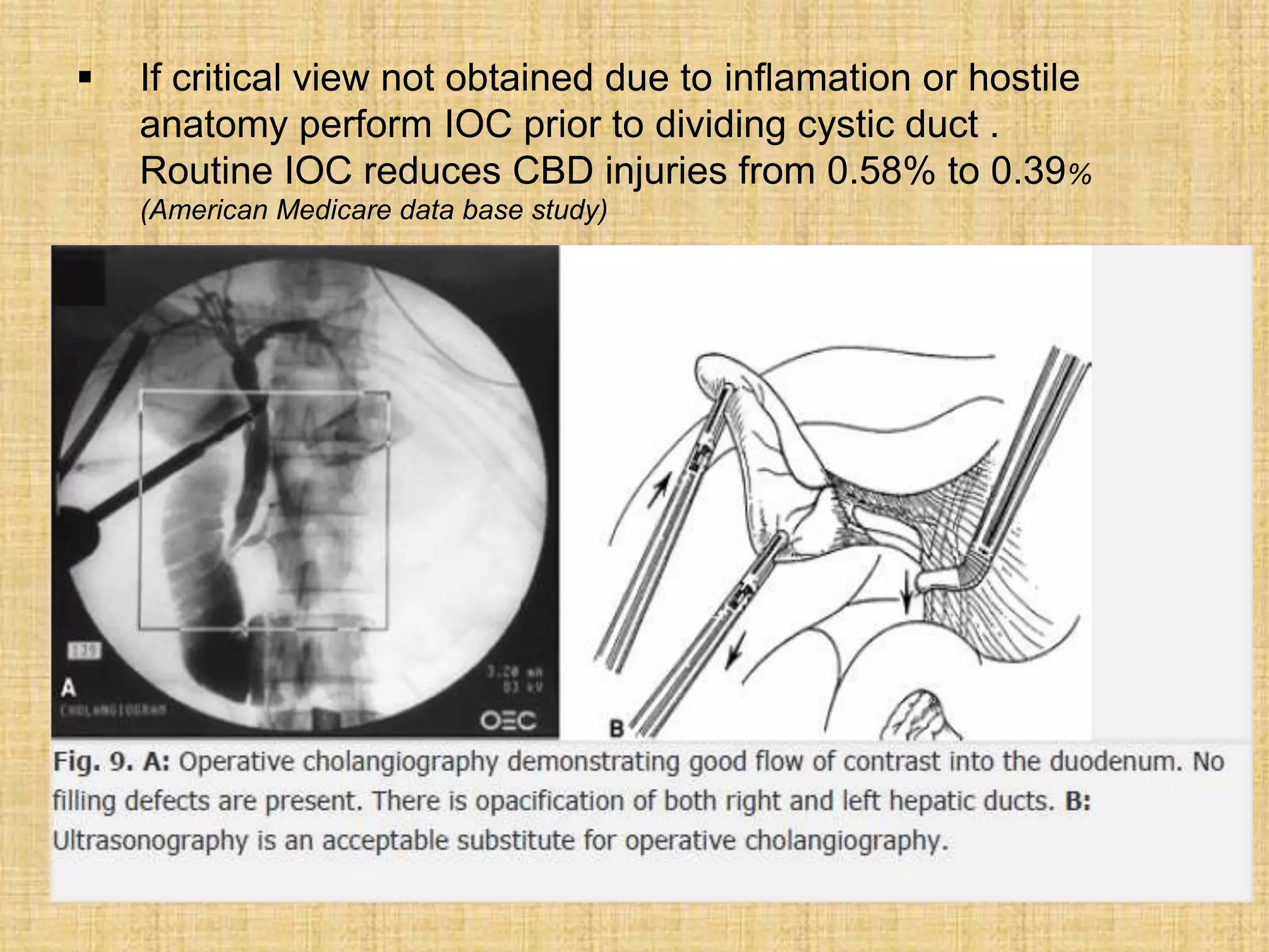 

If critical view not obtained due to inflamation or hostile
anatomy perform IOC prior to dividing cystic duct .
Routine IOC reduces CBD injuries from 0.58% to 0.39%
(American Medicare data base study)

 