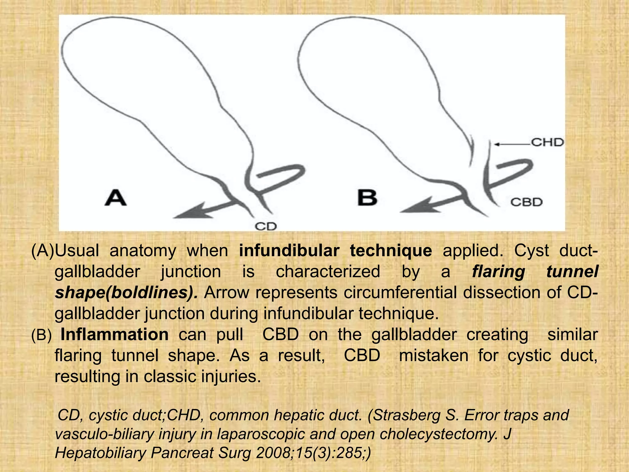 (A)Usual anatomy when infundibular technique applied. Cyst ductgallbladder junction is characterized by a flaring tunnel
shape(boldlines). Arrow represents circumferential dissection of CDgallbladder junction during infundibular technique.
(B) Inflammation can pull CBD on the gallbladder creating similar
flaring tunnel shape. As a result, CBD mistaken for cystic duct,
resulting in classic injuries.
CD, cystic duct;CHD, common hepatic duct. (Strasberg S. Error traps and
vasculo-biliary injury in laparoscopic and open cholecystectomy. J
Hepatobiliary Pancreat Surg 2008;15(3):285;)

 