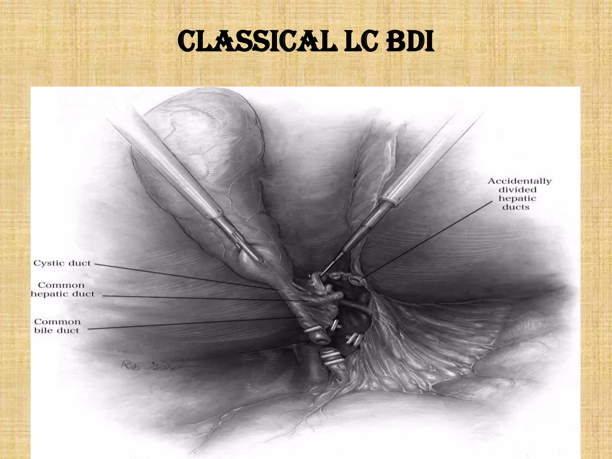 Classical LC BDI

 