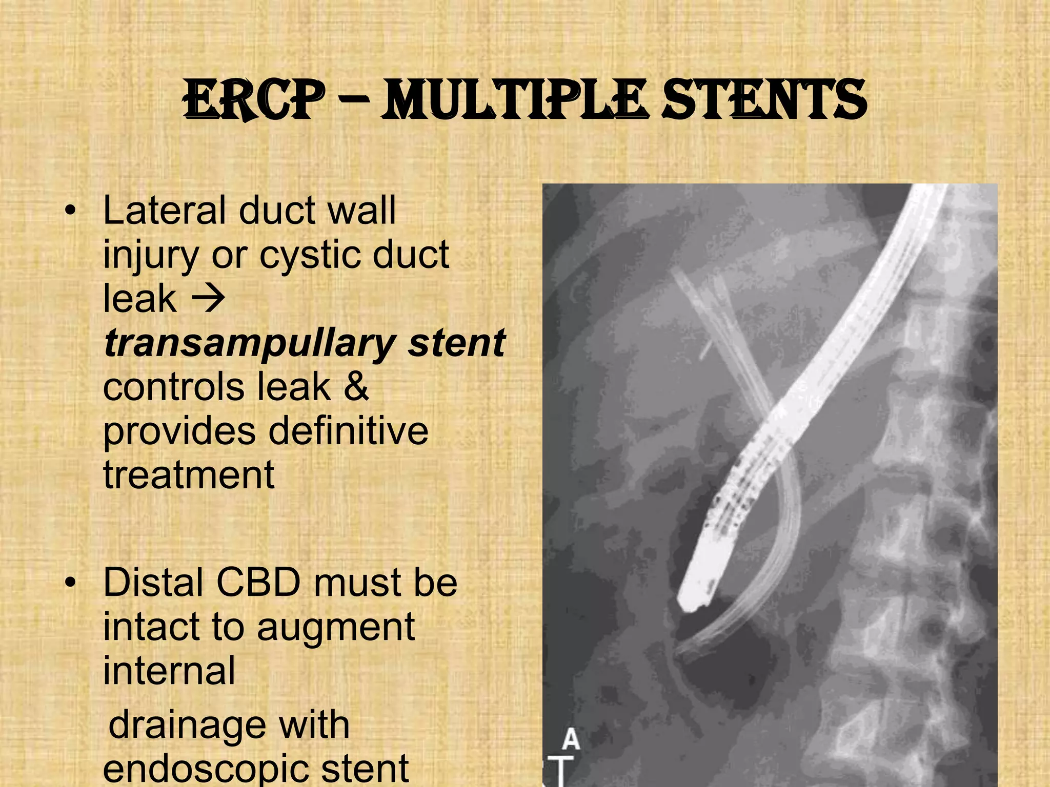 ERCP – multiple stents
• Lateral duct wall
injury or cystic duct
leak 
transampullary stent
controls leak &
provides definitive
treatment
• Distal CBD must be
intact to augment
internal
drainage with
endoscopic stent

 