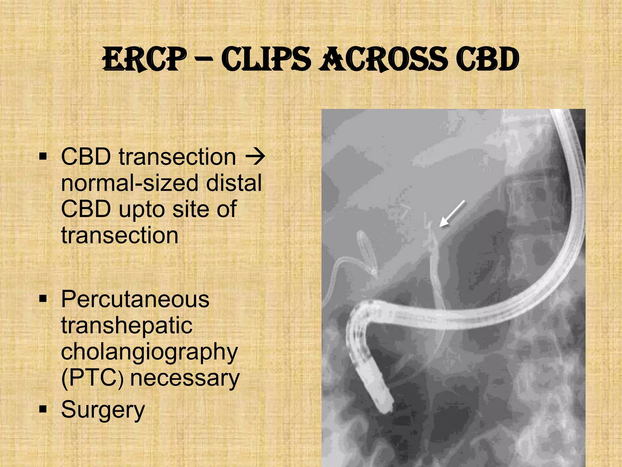 ERCP – clips across CBD
 CBD transection 
normal-sized distal
CBD upto site of
transection
 Percutaneous
transhepatic
cholangiography
(PTC) necessary
 Surgery

 