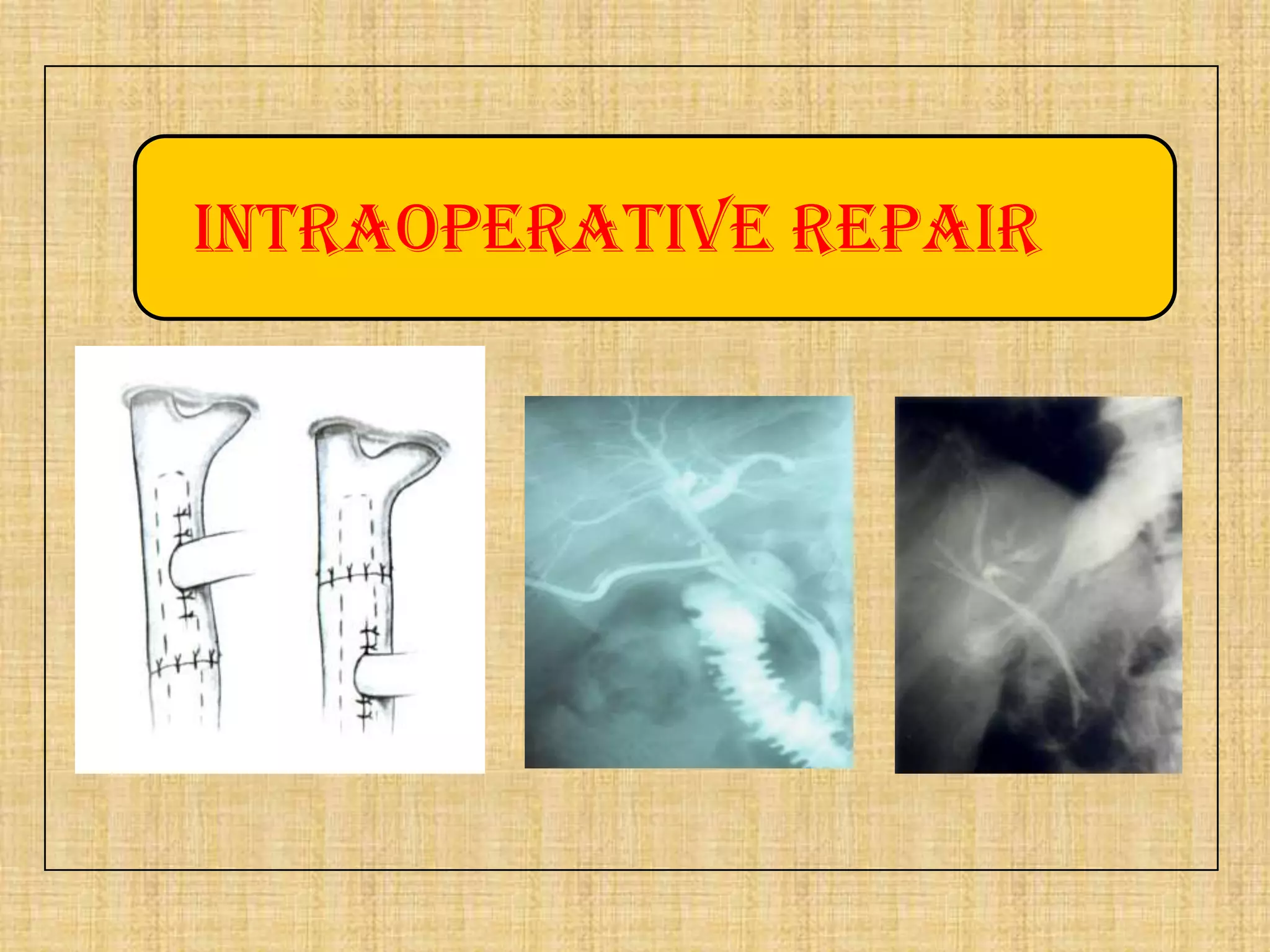 Intraoperative repair

 