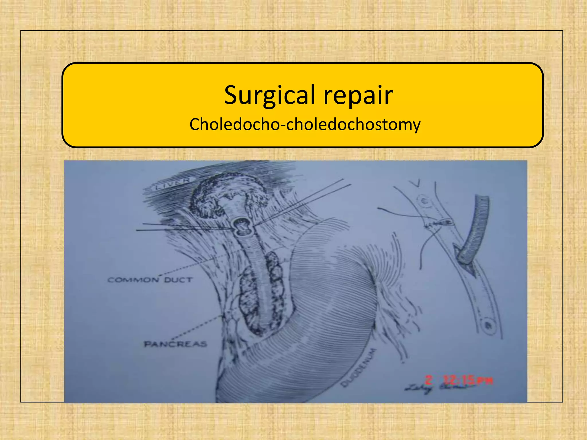 Surgical repair
Choledocho-choledochostomy

 