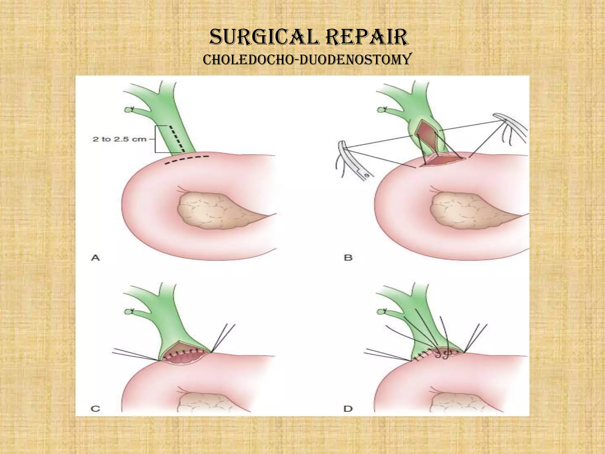 Surgical repair
Choledocho-duodenostomy

 
