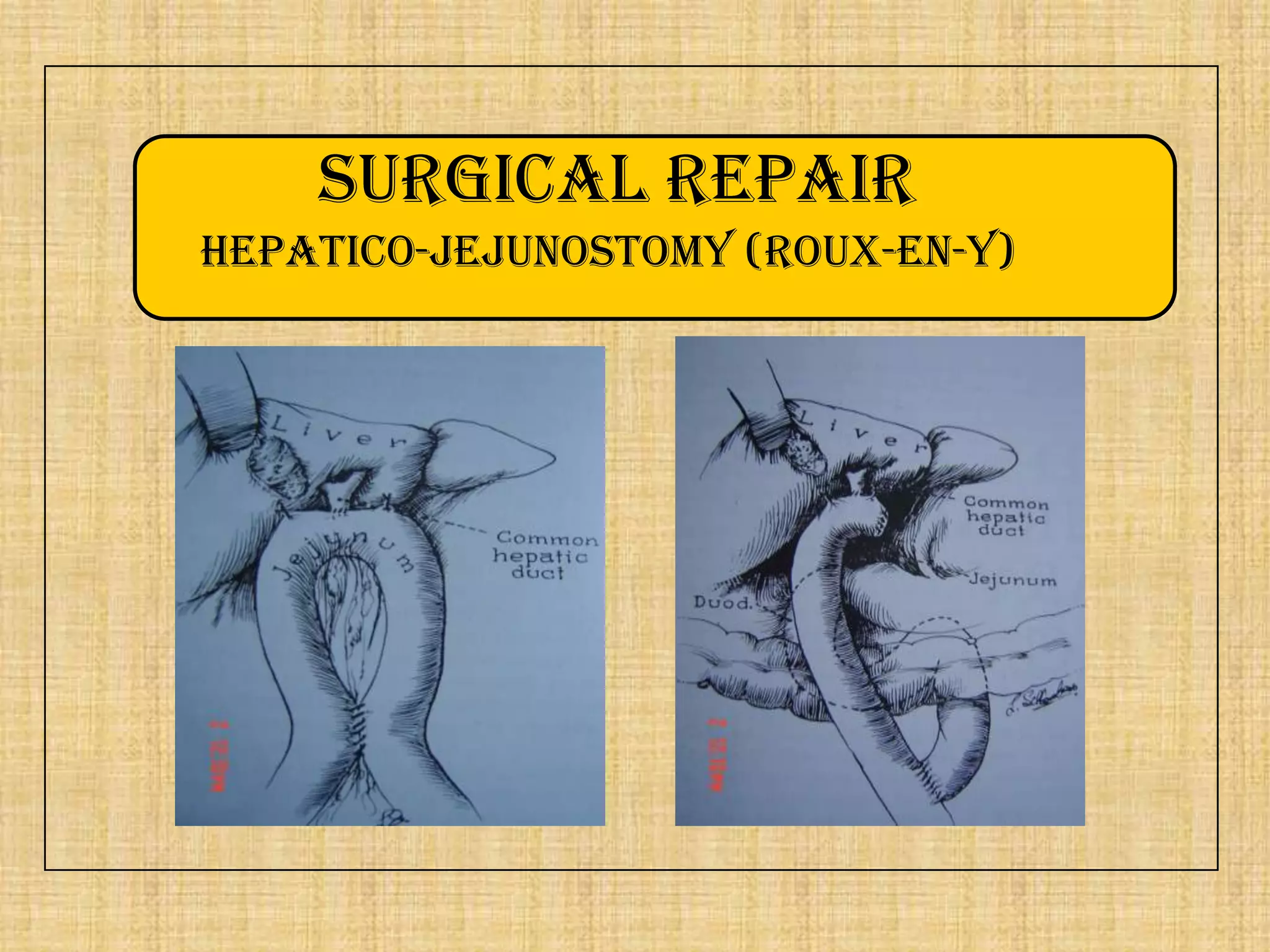Surgical repair
Hepatico-jejunostomy (Roux-en-Y)

 
