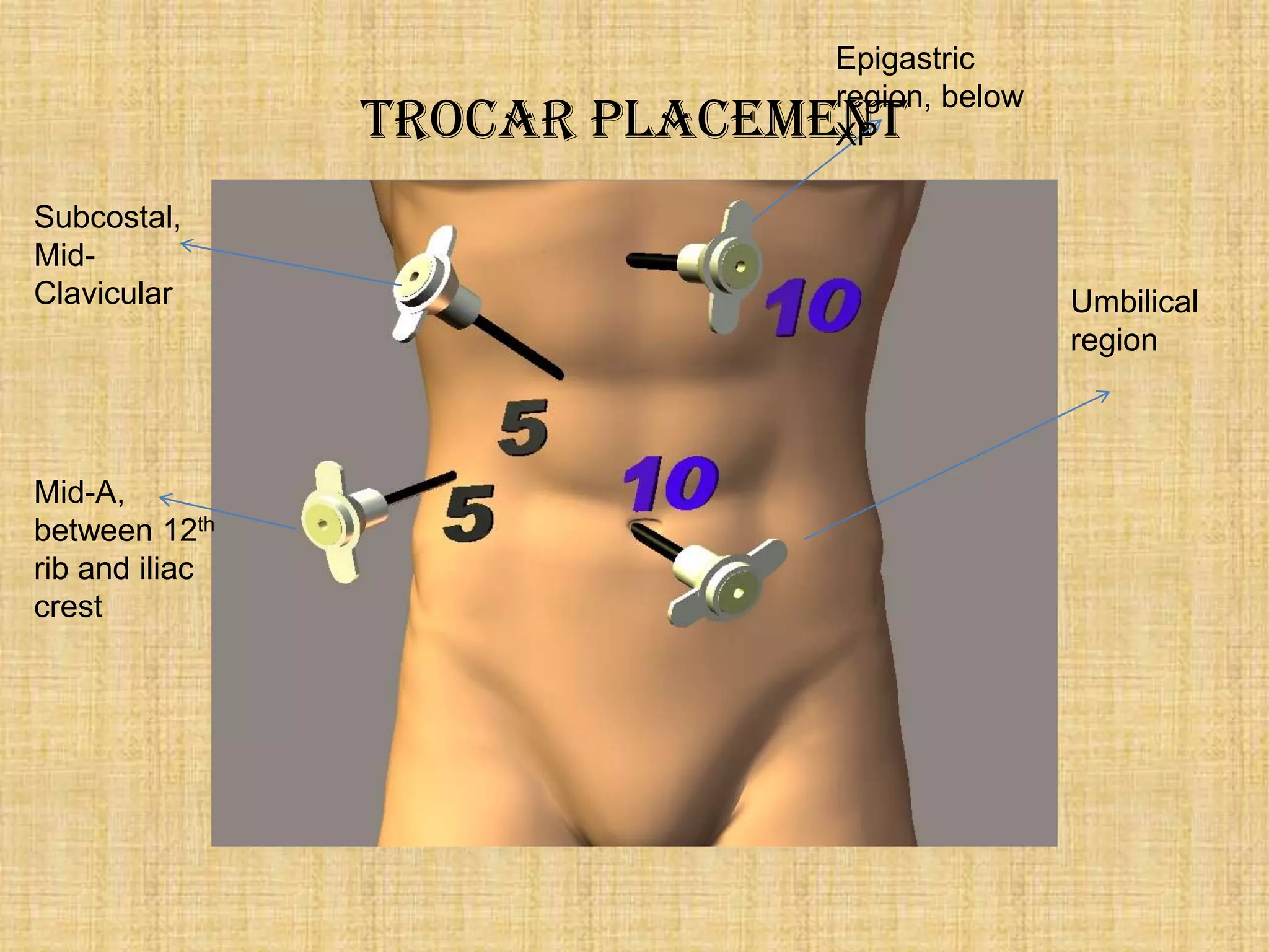 Epigastric
region, below
XP

Trocar Placement
Subcostal,
MidClavicular

Mid-A,
between 12th
rib and iliac
crest

Umbilical
region

 