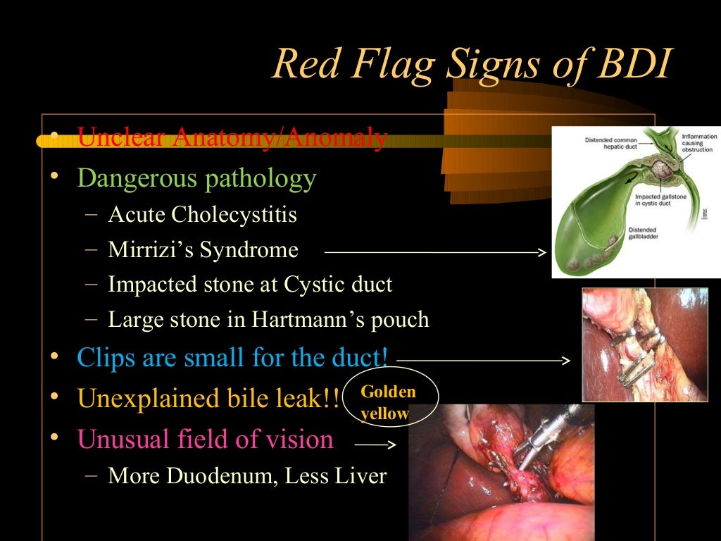 Bile duct injury during laparoscopic cholecystectomy