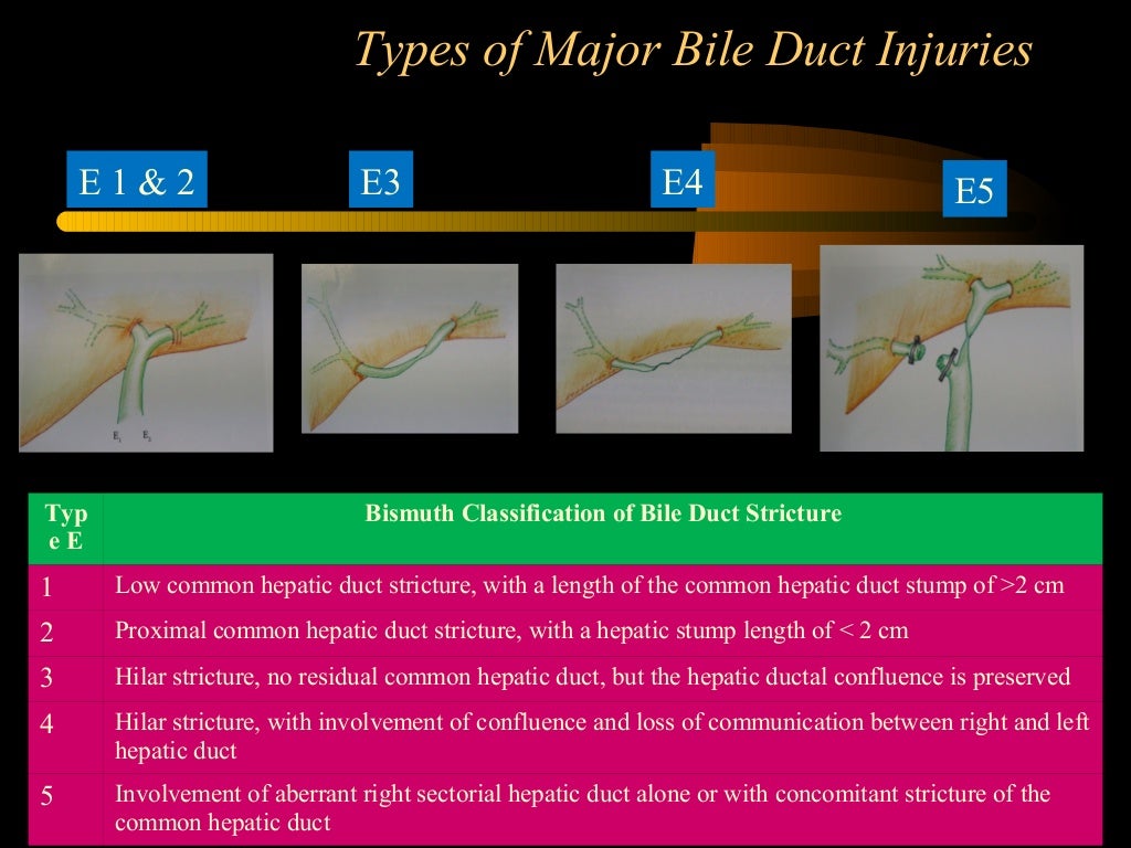 Bile Duct Injury During Laparoscopic Cholecystectomy Bile Duct Injury During Laparoscopic Cholecystectomy