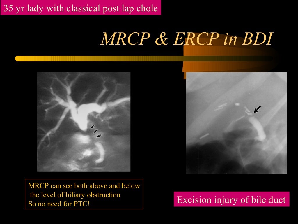 Bile Duct Injury During Laparoscopic Cholecystectomy Bile Duct Injury During Laparoscopic Cholecystectomy
