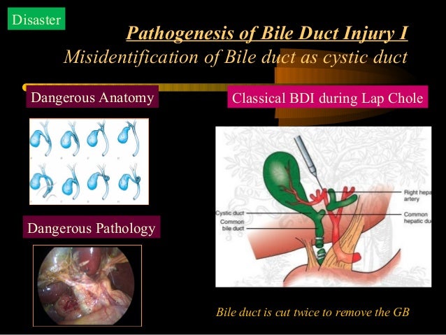 Bile Duct Injury During Laparoscopic Cholecystectomy Bile Duct Injury During Laparoscopic Cholecystectomy
