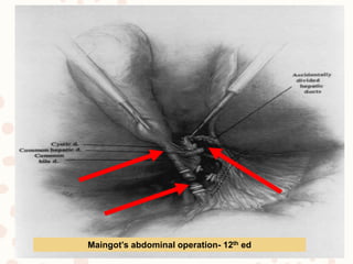 Bile duct injury | PPTX