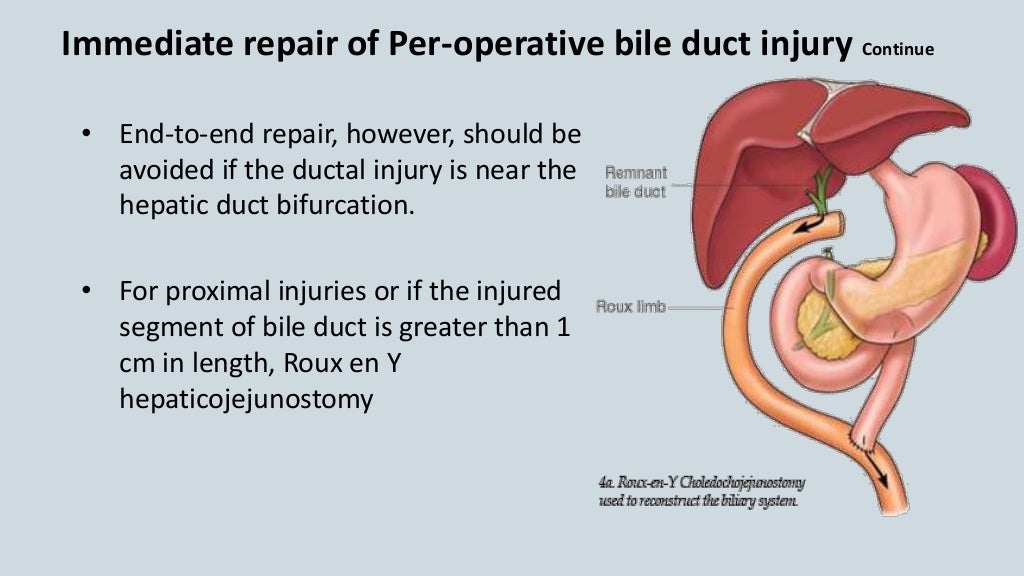 Bile Duct Injury and Post Cholecystectomy Biliary Stricture