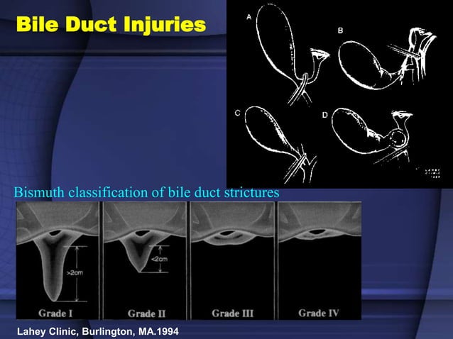 BILE DUCT INJURY 09-05.ppt