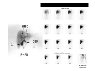 bile duct injury investigations 2nd part.pptx