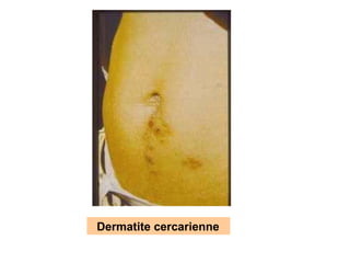 Dermatite cercarienne
 