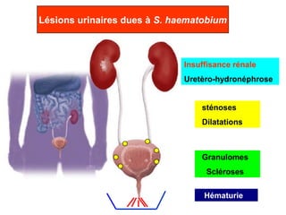 Lésions urinaires dues à S. haematobium



                              Insuffisance rénale
                              Uretèro-hydronéphrose


                                  sténoses
                                  Dilatations



                                  Granulomes
                                   Scléroses

                                   Hématurie
 