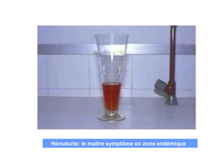 Hématurie: le maître symptôme en zone endémique
 