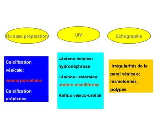 Rx sans préparation           UIV               Echographie




                      Lésions rénales:
Calcification
                      hydronéphrose           Irrégularités de la
vésicale:
                                              paroi vésicale:
                      Lésions urétérales:
vessie porcelaine                             mamelonnée,
                      uretère moniliforme
Calcification                                 polypes
                      Reflux vesico-urétral
urétérales
 