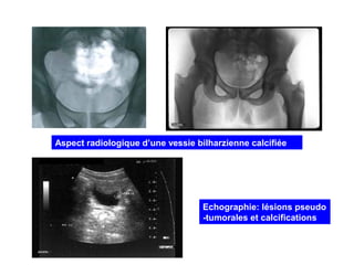 Aspect radiologique d’une vessie bilharzienne calcifiée




                                   Echographie: lésions pseudo
                                   -tumorales et calcifications
 