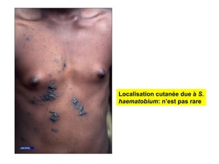 Localisation cutanée due à S.
haematobium: n’est pas rare
 