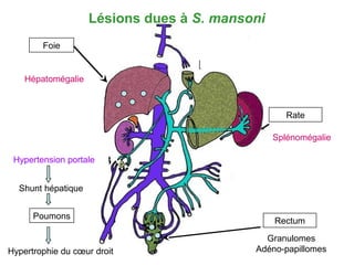 Lésions dues à S. mansoni
        Foie


    Hépatomégalie



                                                   Rate

                                                Splénomégalie

 Hypertension portale


  Shunt hépatique


      Poumons
                                                Rectum
                                             Granulomes
Hypertrophie du cœur droit                 Adéno-papillomes
 