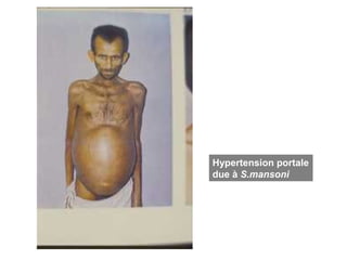 Hypertension portale
due à S.mansoni
 