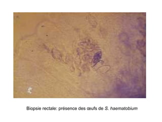 Biopsie rectale: présence des œufs de S. haematobium
 