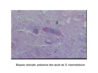 Biopsie vésicale: présence des œufs de S. haematobium
 