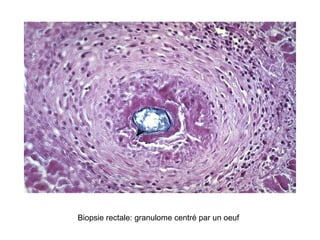 Biopsie rectale: granulome centré par un oeuf
 