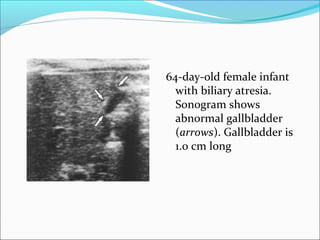 64-day-old female infant
with biliary atresia.
Sonogram shows
abnormal gallbladder
(arrows). Gallbladder is
1.0 cm long
 