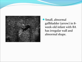 Small, abnormal
gallbladder (arrow) in 8-
week-old infant with BA
has irregular wall and
abnormal shape.
 