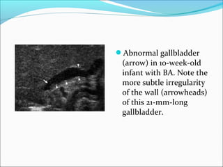 Abnormal gallbladder
(arrow) in 10-week-old
infant with BA. Note the
more subtle irregularity
of the wall (arrowheads)
of this 21-mm-long
gallbladder.
 