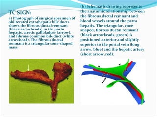 TC SIGN:
a) Photograph of surgical specimen of
obliterated extrahepatic bile ducts
shows the fibrous ductal remnant
(black arrowheads) in the porta
hepatis, atretic gallbladder (arrow),
and fibrous common bile duct (white
arrowhead). The fibrous ductal
remnant is a triangular cone-shaped
mass
(b) Schematic drawing represents
the anatomic relationship between
the fibrous ductal remnant and
blood vessels around the porta
hepatis. The triangular, cone-
shaped, fibrous ductal remnant
(black arrowheads, green) is
positioned anterior and slightly
superior to the portal vein (long
arrow, blue) and the hepatic artery
(short arrow, red).
 