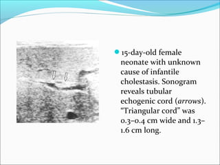 15-day-old female
neonate with unknown
cause of infantile
cholestasis. Sonogram
reveals tubular
echogenic cord (arrows).
“Triangular cord” was
0.3–0.4 cm wide and 1.3–
1.6 cm long.
 