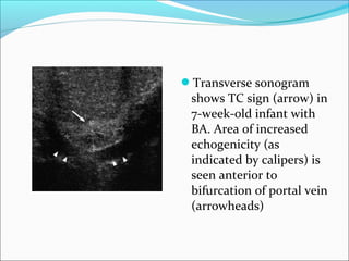 Transverse sonogram
shows TC sign (arrow) in
7-week-old infant with
BA. Area of increased
echogenicity (as
indicated by calipers) is
seen anterior to
bifurcation of portal vein
(arrowheads)
 