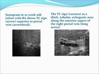 Sonogram in 10-week-old
infant with BA shows TC sign
(arrow) superior to portal
vein (arrowhead).
The TC sign (cursors) as a
thick, tubular, echogenic area
along the anterior aspect of
the right portal vein (long
arrow)
 