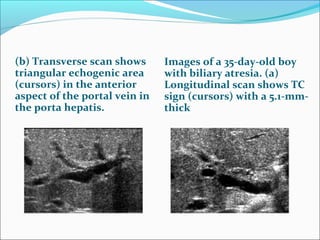 (b) Transverse scan shows
triangular echogenic area
(cursors) in the anterior
aspect of the portal vein in
the porta hepatis.
Images of a 35-day-old boy
with biliary atresia. (a)
Longitudinal scan shows TC
sign (cursors) with a 5.1-mm-
thick
 