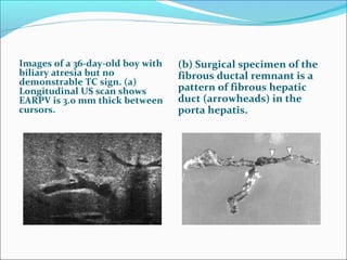 Images of a 36-day-old boy with
biliary atresia but no
demonstrable TC sign. (a)
Longitudinal US scan shows
EARPV is 3.0 mm thick between
cursors.
(b) Surgical specimen of the
fibrous ductal remnant is a
pattern of fibrous hepatic
duct (arrowheads) in the
porta hepatis.
 