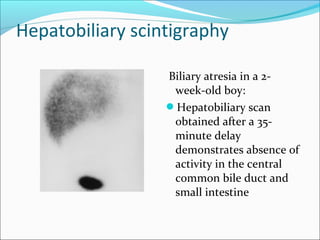 Hepatobiliary scintigraphy
Biliary atresia in a 2-
week-old boy:
Hepatobiliary scan
obtained after a 35-
minute delay
demonstrates absence of
activity in the central
common bile duct and
small intestine
 